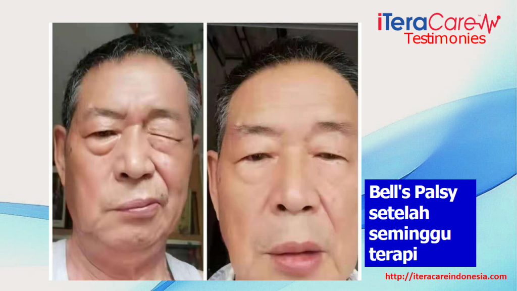 Testimoni - Bell's Palsy
