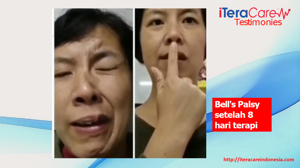 Testimoni - Bell's Palsy2