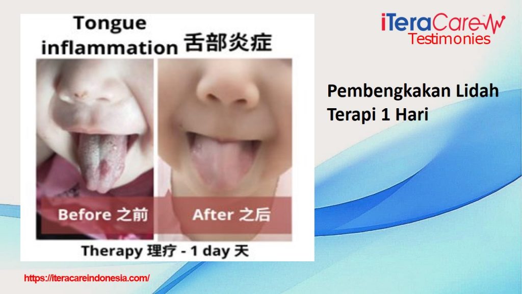 Testimoni - Bengkak Lidah