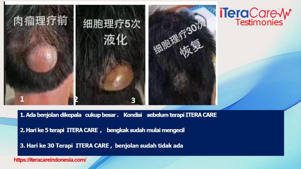 Testimoni - Benjolan