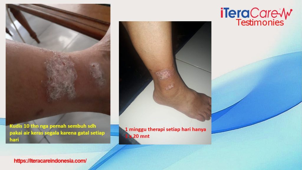 Testimoni - Eczema (Eksim)