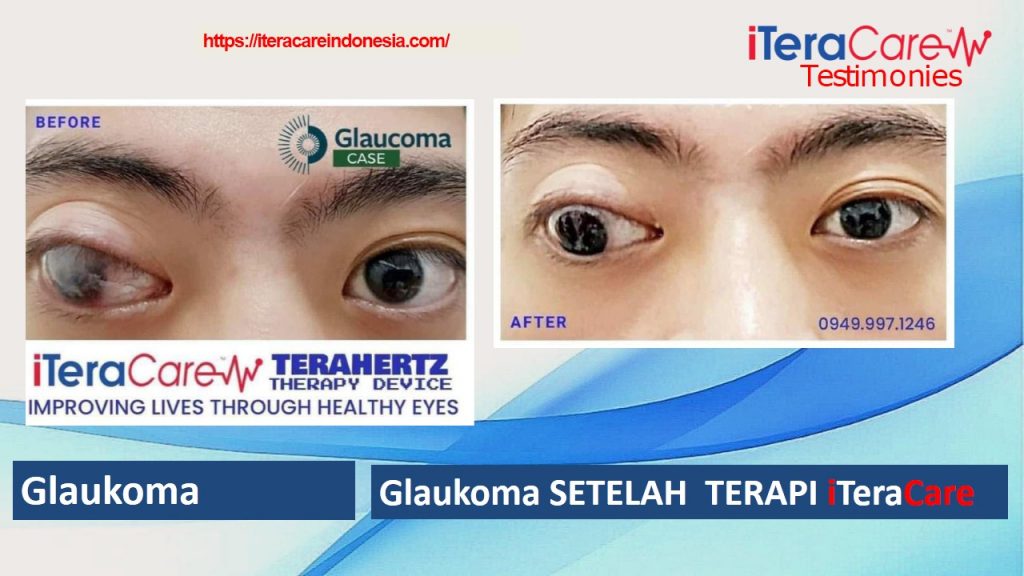 Testimoni - Glaukoma