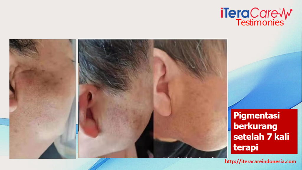 Testimoni - Pigmentasi