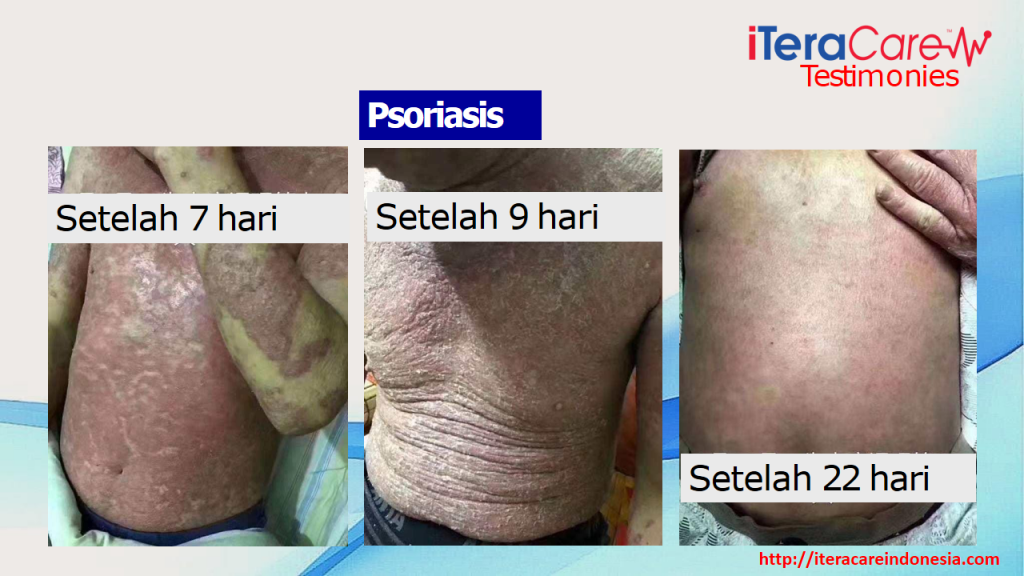 Testimoni - Psoriasis