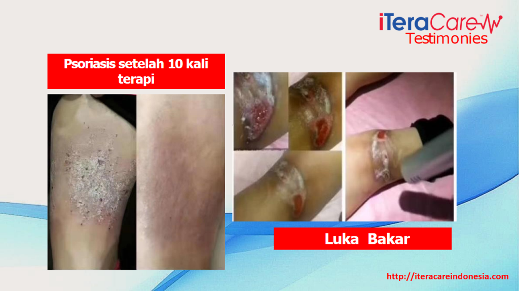 Testimoni - Psoriasis2