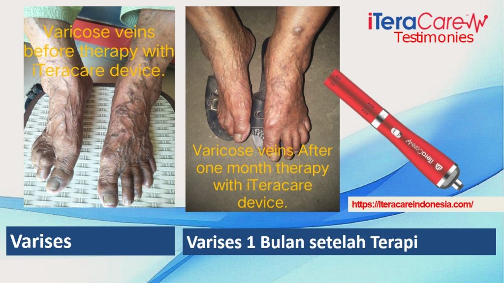 Testimoni - Varises2