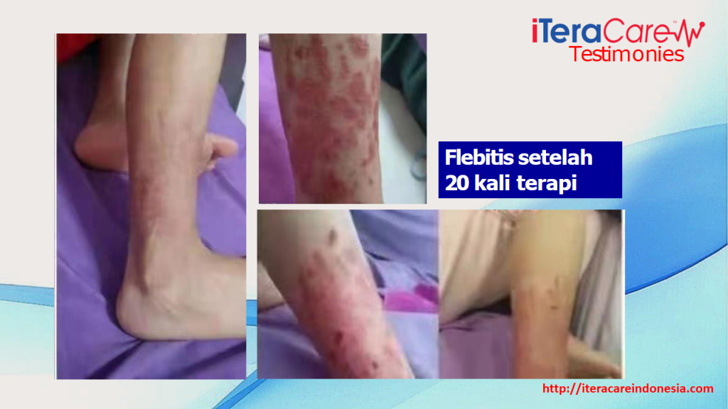 Testimoni - Vaskulitis (Radang Pembuluh Darah)