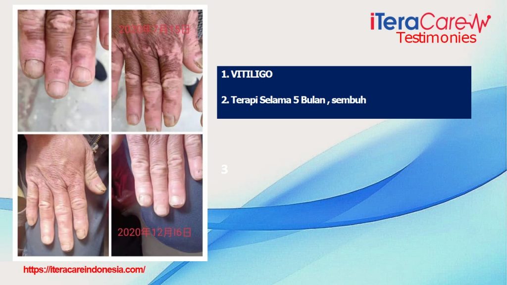 Testimoni - Vitiligo
