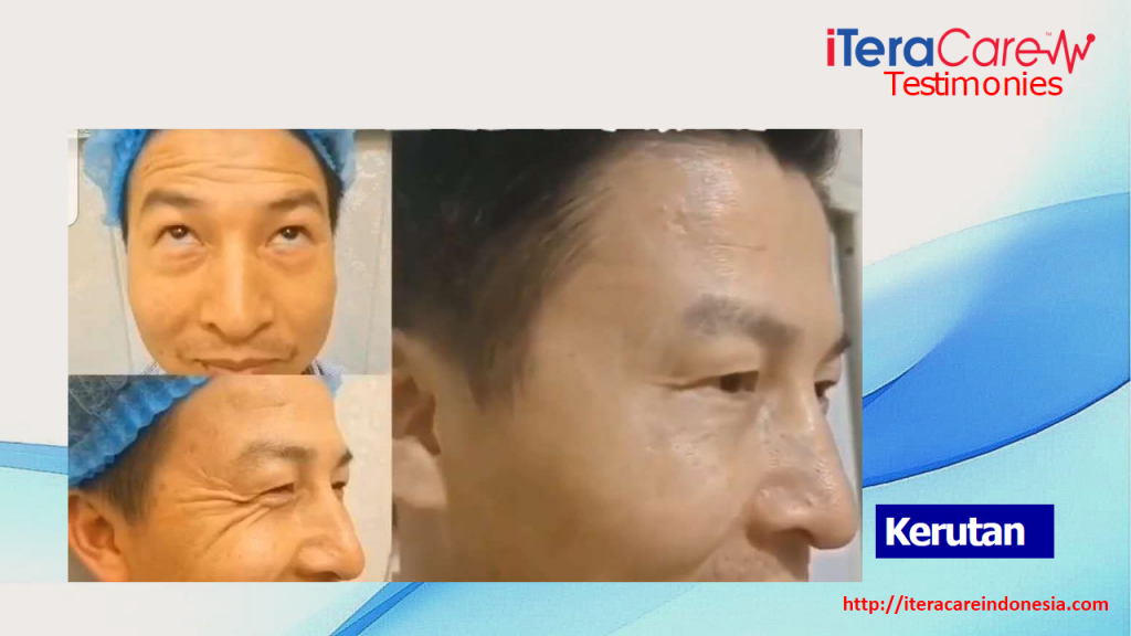 Testimoni - Wajah Kerutan